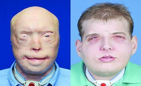 Increíble trasplante facial